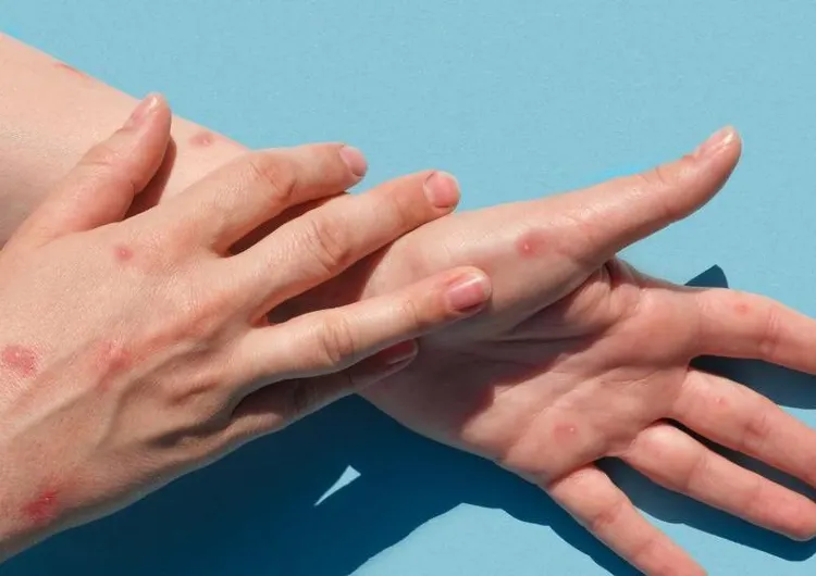 【猴痘病毒】猴痘傳入香港：了解猴痘徵狀、傳染途徑、預防措施、全球案例