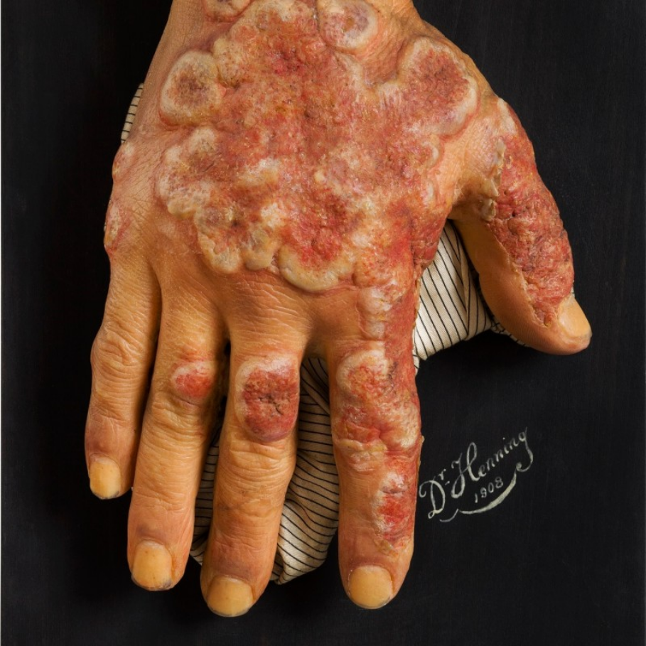 The art of moulage - immortalised clinical images | Natural History Museum