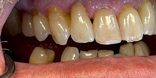 B/ART liquid ceramic training-MiYO | Winter Springs Dental Lab