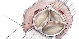 SHEFFIELD AORTIC ROOT SURGERY COURSE, 2025 | Northern General Hospital, Medical Education Centre, Herries Road, Sheffield, UK