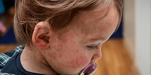 Children with Special Health Care Needs: Allergies and Anaphylaxis | Albemarle Alliance for Children and Families